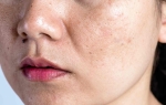 Chăm Sóc Da Tuổi 18 Cần Làm Gì Để Da Khỏe Và Ít Mụn?
