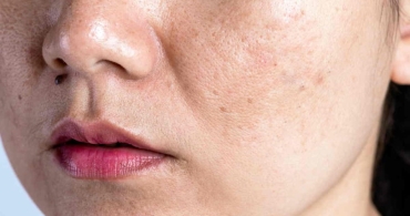 Chăm Sóc Da Tuổi 18 Cần Làm Gì Để Da Khỏe Và Ít Mụn?