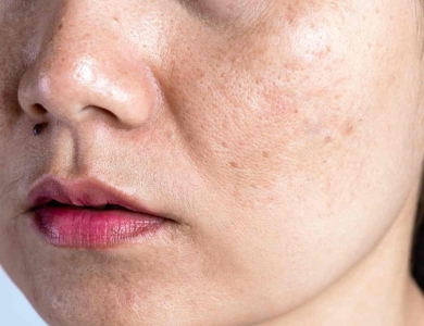 Chăm Sóc Da Tuổi 18 Cần Làm Gì Để Da Khỏe Và Ít Mụn?