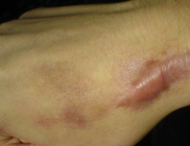 Sẹo lồi là gì? Giải pháp xử lý dứt điểm từ N Beauty