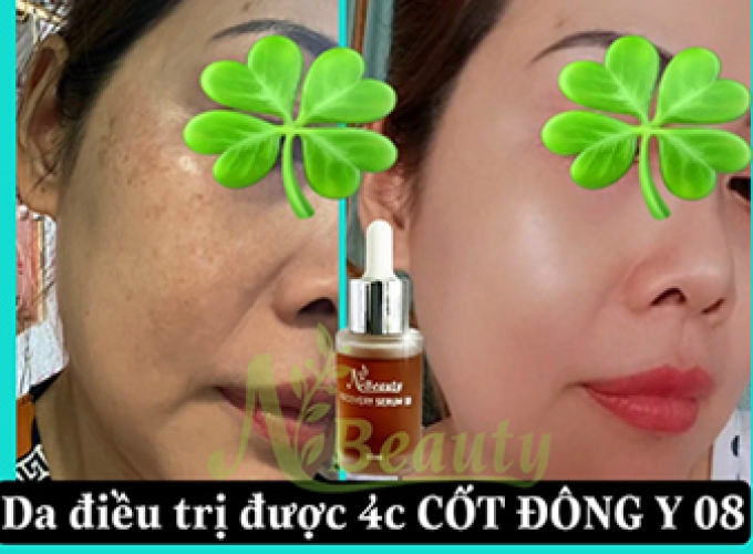 Hiệu quả điều trị cho da cốt đông y 08