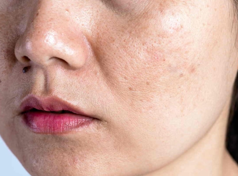 Chăm Sóc Da Tuổi 18 Cần Làm Gì Để Da Khỏe Và Ít Mụn?