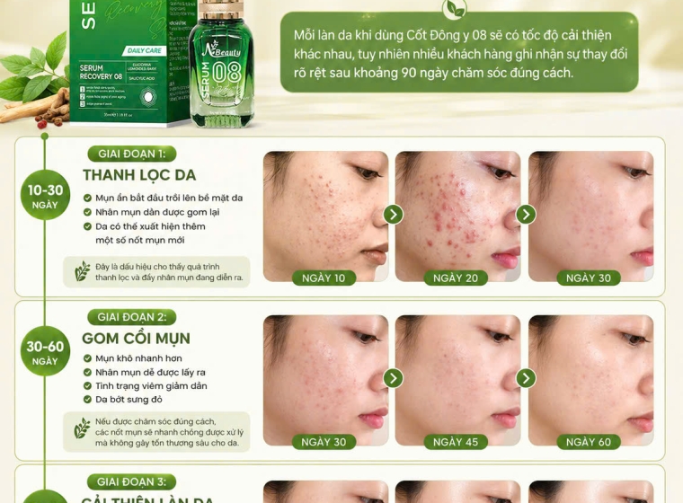 Chỉ 90 ngày – Làn Da Mụn Có Thể Thay Đổi Như Thế Nào?