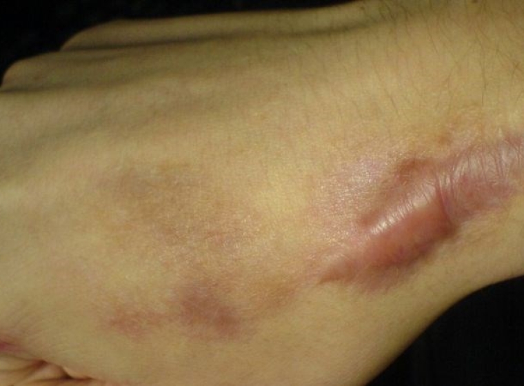 Sẹo lồi là gì? Giải pháp xử lý dứt điểm từ N Beauty